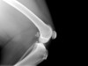 Anterior Cruciate Ligament Tear: What Happens When We Don’t Fix a Torn ACL?